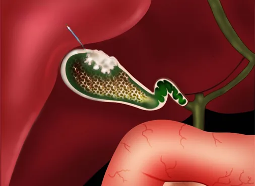 Gallbladder Polyps consultation at Niraaya Hospital